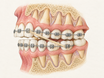 A side-view cross-section of upper and lower teeth, gums, and supporting bone with braces shows an elastic band stretched between upper and lower brackets, illustrating how orthodontic elastics apply gentle continuous force to guide the bite.